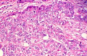 Cancro al seno: metformina, un farmaco per il diabete, utile solo in alcune forme della malattia