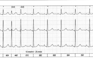 Due battiti ravvicinati. Di che aritmia si tratta? Metti alla prova la tua capacità di analisi