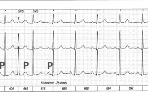 Due battiti ravvicinati: la soluzione
