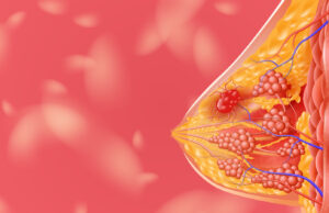 Carcinoma del seno: un prelievo ematico per sapere rapidamente se la terapia funziona