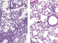 Asma allergica: un nuovo approccio per ridurre l’infiammazione polmonare