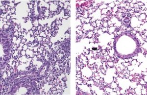 Asma allergica: un nuovo approccio per ridurre l’infiammazione polmonare