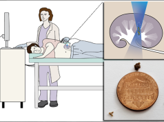 Spingere i calcoli fuori dal rene con gli ultrasuoni riduce le recidive