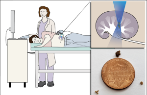 Spingere i calcoli fuori dal rene con gli ultrasuoni riduce le recidive