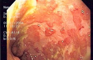 Colite ulcerosa: risultati promettenti nella cura con l’anticorpo monoclonale tulisokibart