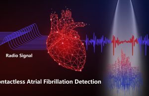 Fibrillazione atriale: un radar controlla il cuore e può rilevare l’aritmia