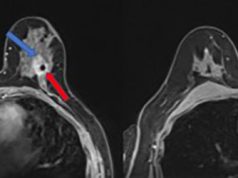 Carcinoma mammario: una sola dose di radiazioni può eradicare il tumore
