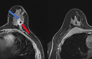 Cancro al seno: fare prevenzione con uno screening personalizzato