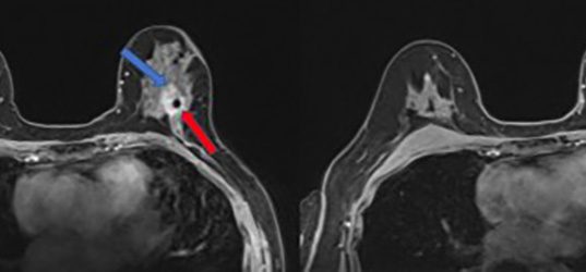 Crescita record dei casi di tumore al seno: nuove sfide per la salute mondiale