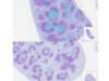 La rivoluzione della Johns Hopkins: nanoparticelle che guidano le cellule T contro tumori e autoimmunità
