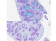 La rivoluzione della Johns Hopkins: nanoparticelle che guidano le cellule T contro tumori e autoimmunità