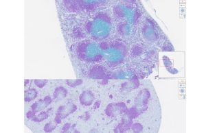 La rivoluzione della Johns Hopkins: nanoparticelle che guidano le cellule T contro tumori e autoimmunità