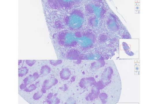 La rivoluzione della Johns Hopkins: nanoparticelle che guidano le cellule T contro tumori e autoimmunità